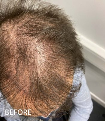 https://millenniumhairlossclinic.ie/wp-content/uploads/2024/07/BEFORE1_1-350x400.jpg