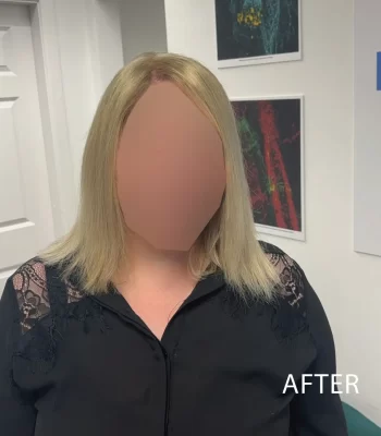https://millenniumhairlossclinic.ie/wp-content/uploads/2024/10/case2-02-350x400.webp